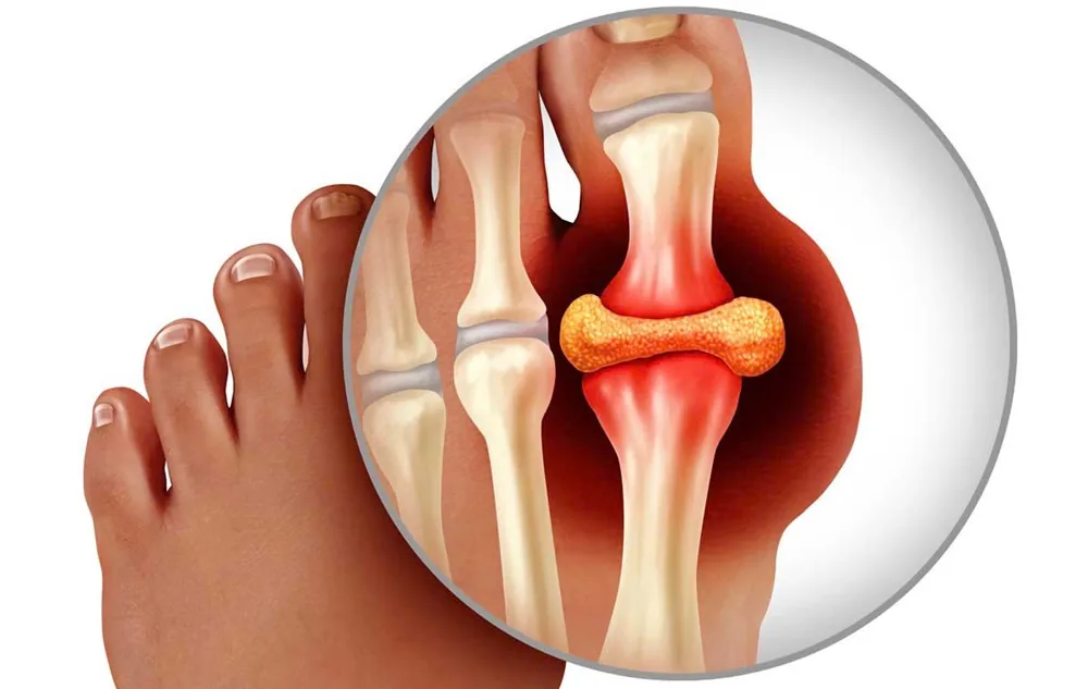 From Severe Pain to Loss of Mobility: The Consequences of Neglecting Gout Treatment - Image 2 - SANTE Hospital, Binh Thanh Ward, HCMC