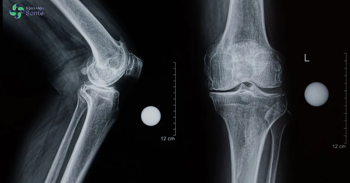 Bệnh viện Sante - Thay Khớp Gối Hết Bao Nhiêu Tiền? Chi Phí Và Mức BHYT Chi Trả 2026 X-ray image of advanced knee osteoarthritis demonstrating severe joint space narrowing and prominent osteophytes