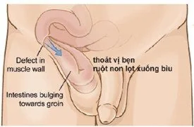 Sante Hospital - Inguinal Hernia Sante Hospital - Inguinal Hernia