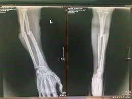 전완부(하완) 골절 X-ray 전완부 골절 X-ray - 산테 병원 빈탄, 호치민시