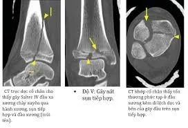 원위 경골 골절 CT 검사 원위 경골 골절 CT scan - 산테 병원 빈탄, 호치민시