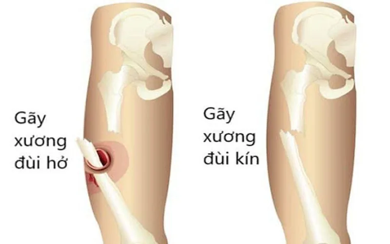 대퇴골 골절 대퇴골 골절 - 호치민시 빈탄 산테(SANTE) 병원